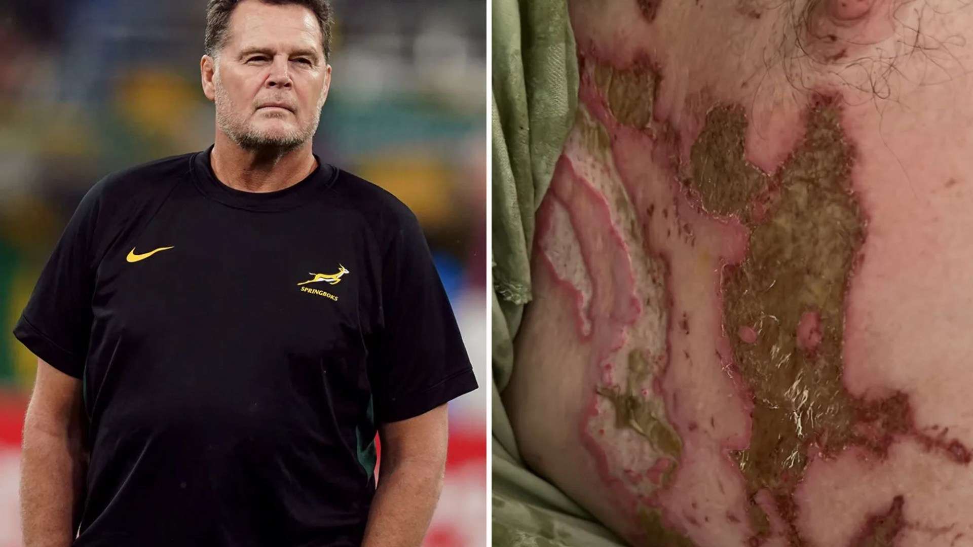 South Africa rugby boss Rassie Erasmus tweets pictures of horror chemical burns after nasty detergent accident South Africa rugby boss Rassie Erasmus tweets pictures of horror chemical burns after nasty detergent accident