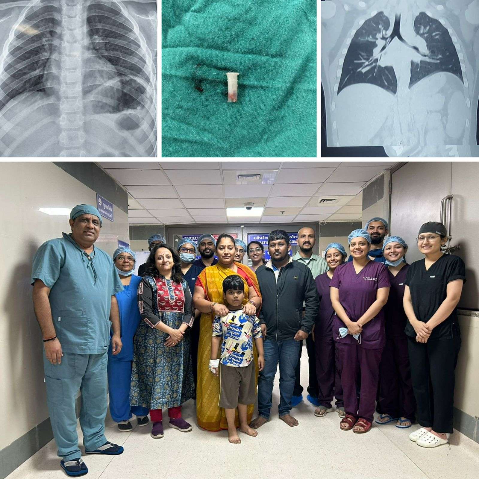 Child swallows whistle: whistling even while breathing: civil surgeons perform complex surgery
