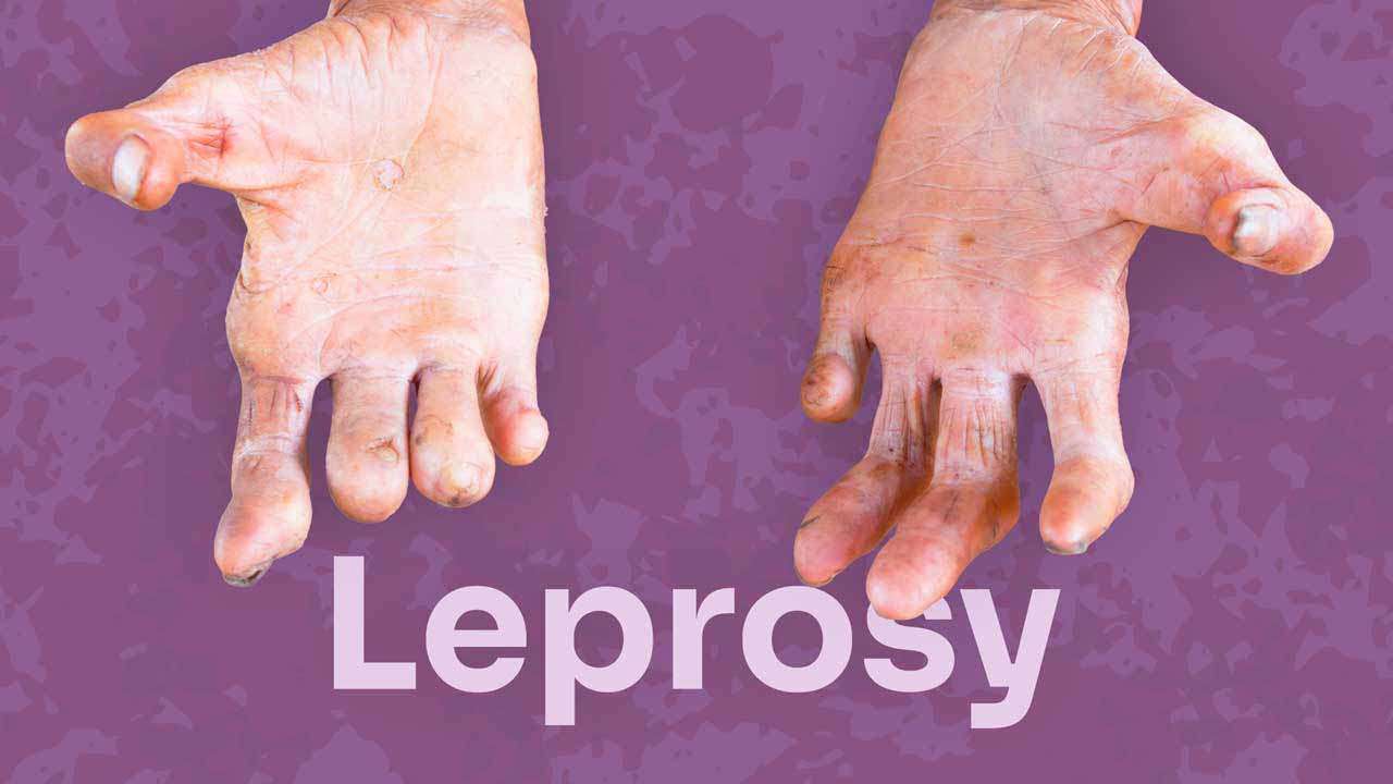 Testing will be done in areas where the highest number of leprosy cases have been reported in the last 5 years